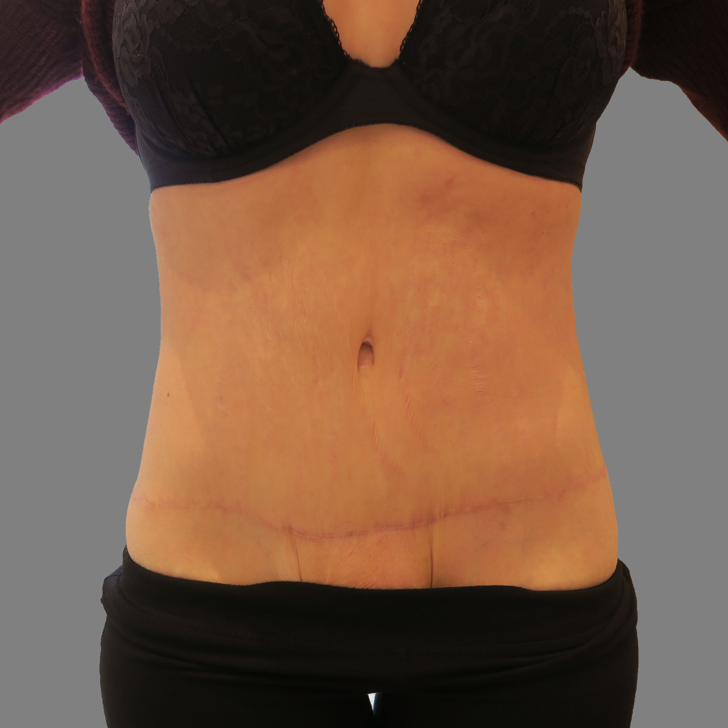 The Plastic Surgery Group Abdominoplasty