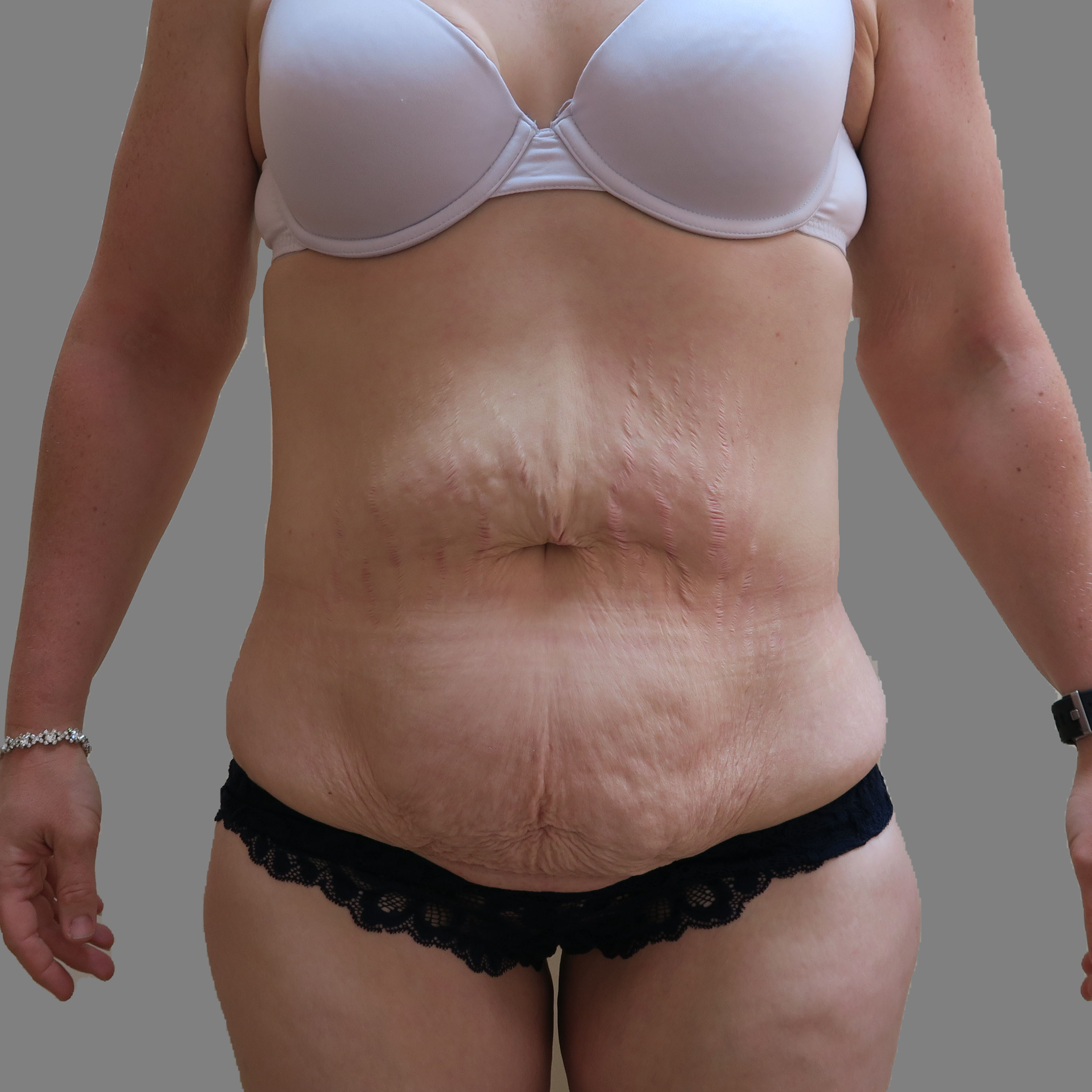 Abdominoplasty